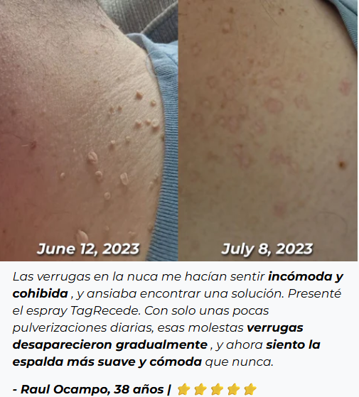 ADIÓS VERRUGAS - Eliminador de Verrugas y Manchas - TAG RECEDE